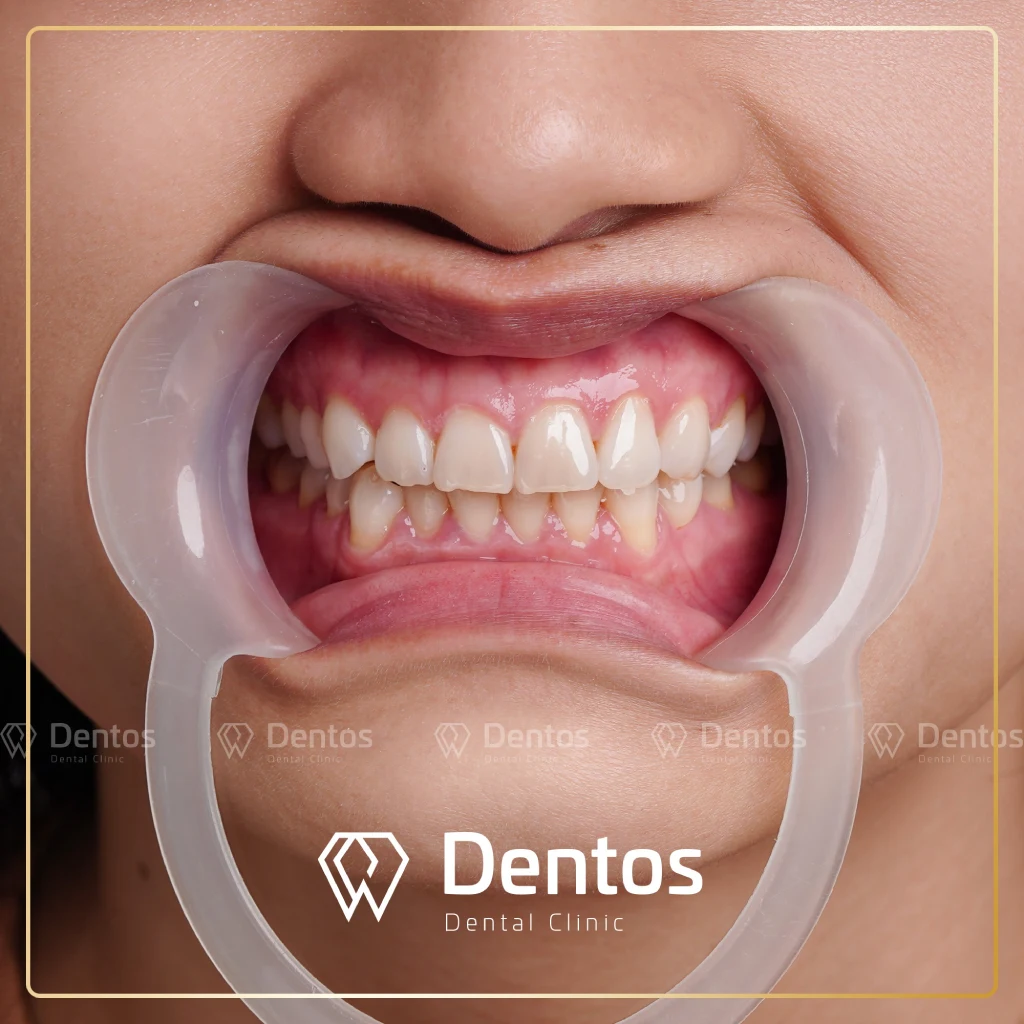 Răng bị sứt mẻ nhẹ nên ưu tiên dán Veneer